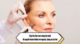 Cấy tóc lên sẹo căng da mặt: Bí quyết hoàn thiện vẻ ngoài, tăng sự tự tin