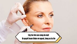Cấy tóc lên sẹo căng da mặt: Bí quyết hoàn thiện vẻ ngoài, tăng sự tự tin