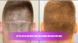 Cấy tóc lên sẹo sau phẫu thuật được không? Hiệu quả ở mức nào?