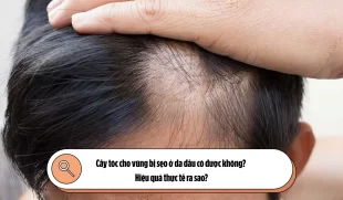 Cấy tóc cho vùng bị sẹo ở da đầu có được không? Hiệu quả thực tế ra sao?