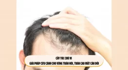 Cấy tóc chữ M – Giải pháp cứu cánh cho vùng trán hói, trán cao mất cân đối