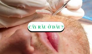 Nam giới thắc mắc: Cấy râu ở đâu đẹp và an toàn hiện nay?
