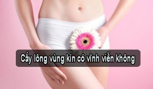 Cấy lông vùng kín có vĩnh viễn không? Giải đáp từ bác sĩ chuyên khoa