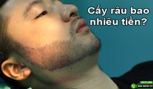[Giải đáp thắc mắc] : Cấy râu bao nhiêu tiền?