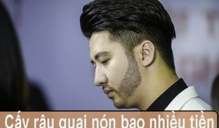 Cấy râu quai nón hết bao nhiêu tiền, có đáng đầu tư?