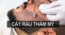 Cấy râu thẩm mỹ – Bí quyết để nam giới tự tin, lịch lãm và đầy cuốn hút