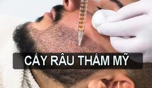 Cấy râu thẩm mỹ – Bí quyết để nam giới tự tin, lịch lãm và đầy cuốn hút