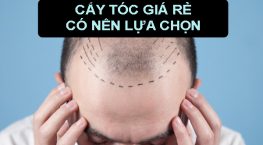 Cấy tóc giá rẻ – Có nên lựa chọn và đâu là địa chỉ đáng tin cậy?
