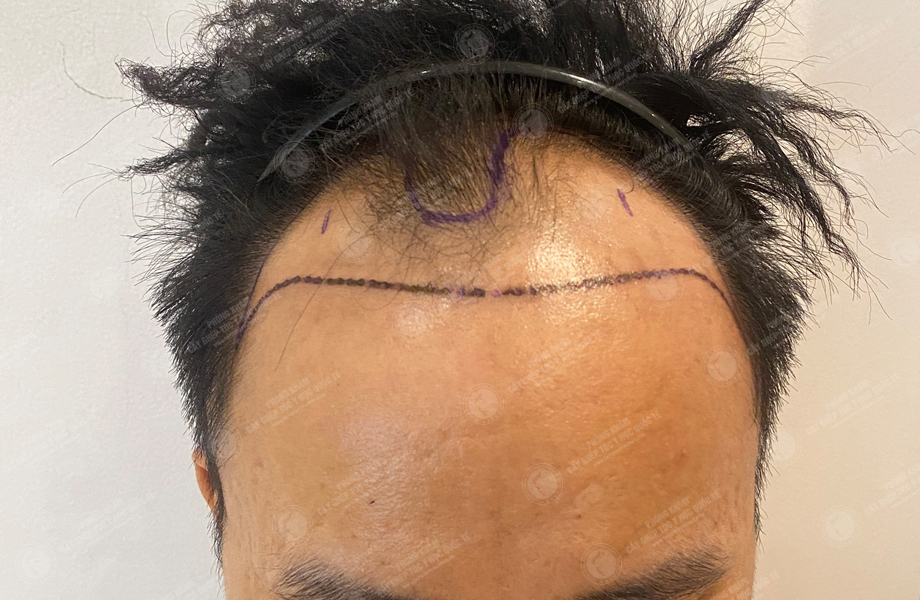 Phạm Văn Huân - Cấy tóc đường chữ M 3