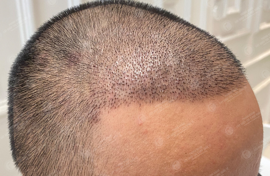 Phạm Văn Huân - Cấy tóc đường chữ M 5