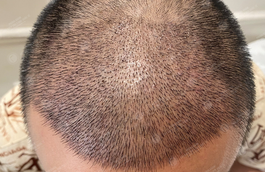 Phạm Văn Huân - Cấy tóc đường chữ M 6