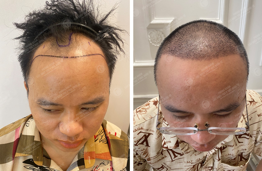  Phạm Văn Huân - Cấy tóc đường chữ M 1