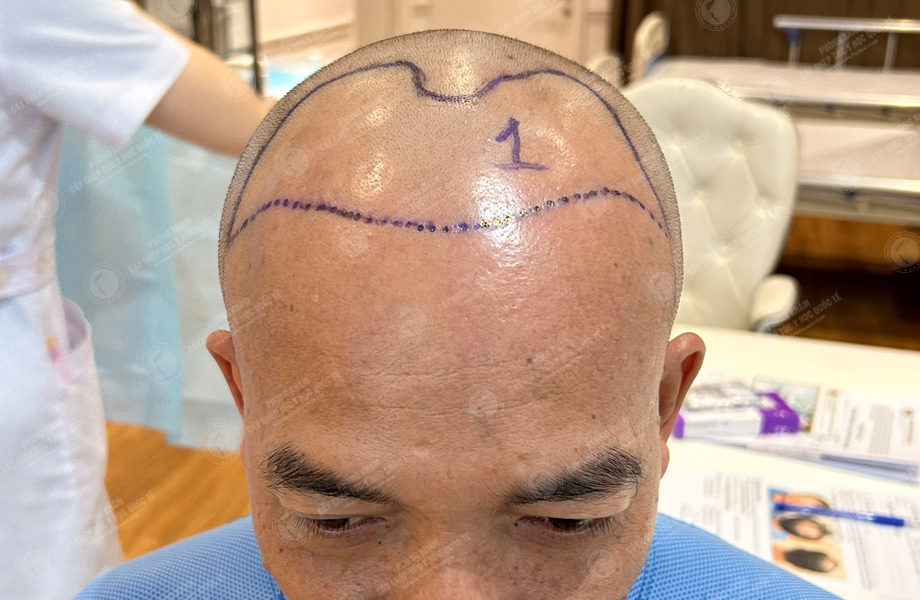 Nguyễn Đăng Linh - Cấy tóc đường chữ M 2