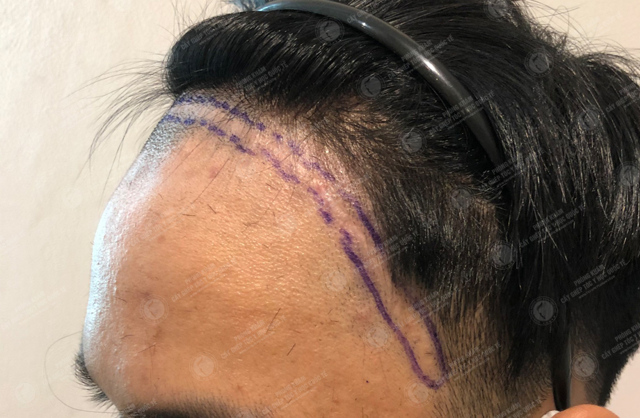 Phạm Quang Hùng - Cấy tóc trên sẹo 2