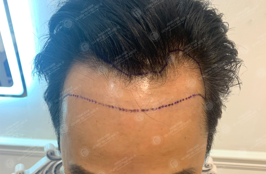 Phùng Tuấn Sơn - Cấy tóc đường chữ M 2