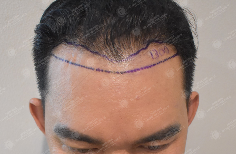 Phạm Hùng Dũng - Cấy tóc đường chữ M 2