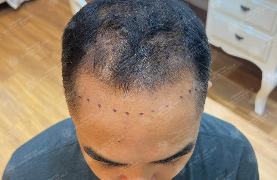 Phạm Hoàng Tuấn - Cấy tóc đường chữ M 2