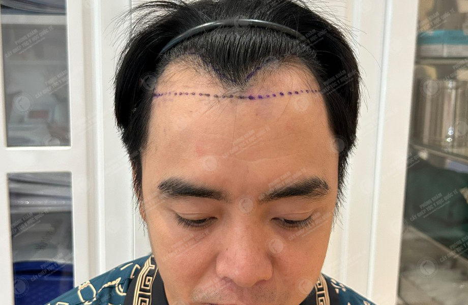 Nguyễn Lạc Quân - Cấy tóc đường chữ M 2