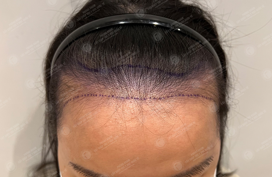 Lê Khánh Thy - Cấy tóc đường chữ M 2