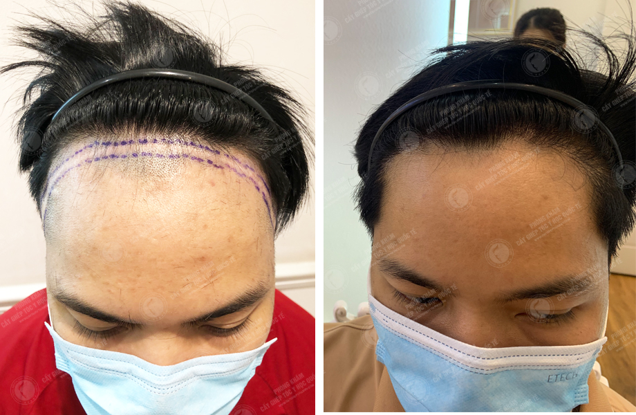  Phạm Quang Hùng - Cấy tóc trên sẹo 1