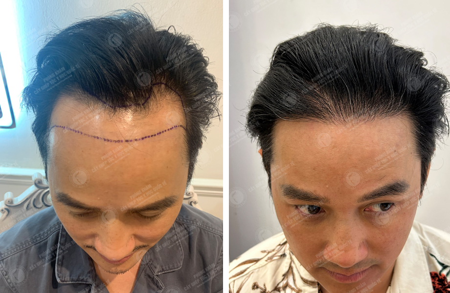  Phùng Tuấn Sơn - Cấy tóc đường chữ M 1