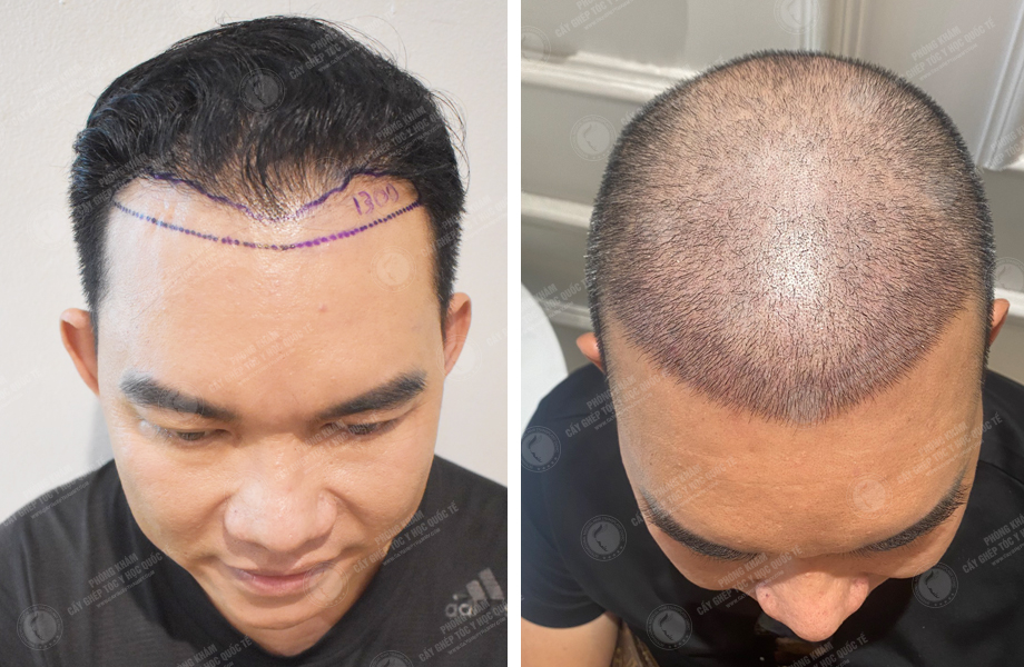  Phạm Hùng Dũng - Cấy tóc đường chữ M 1