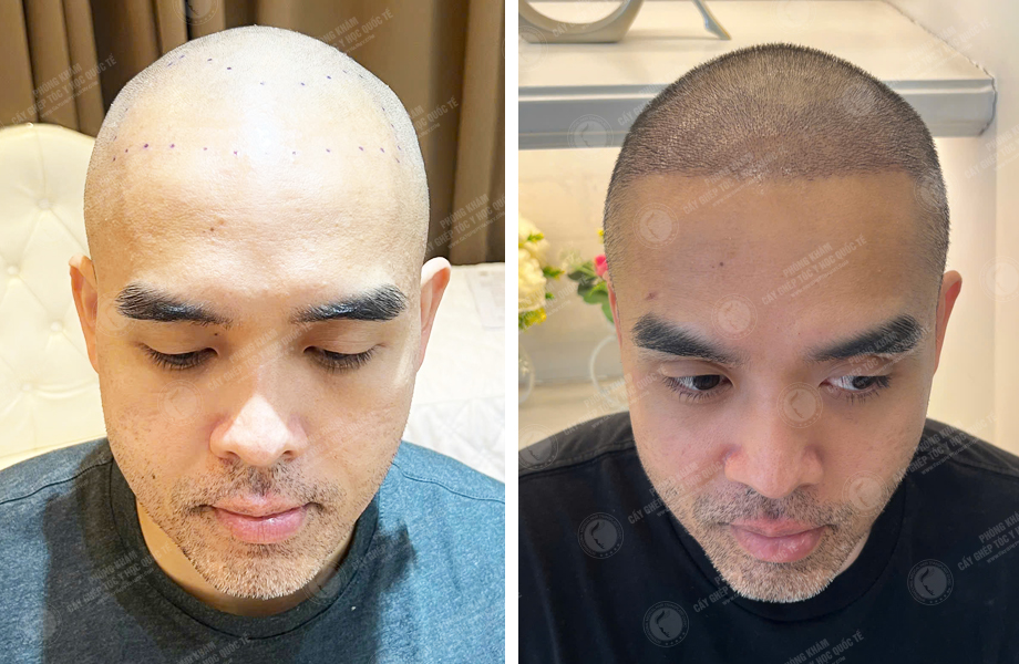  Phạm Hoàng Tuấn - Cấy tóc tự thân 1