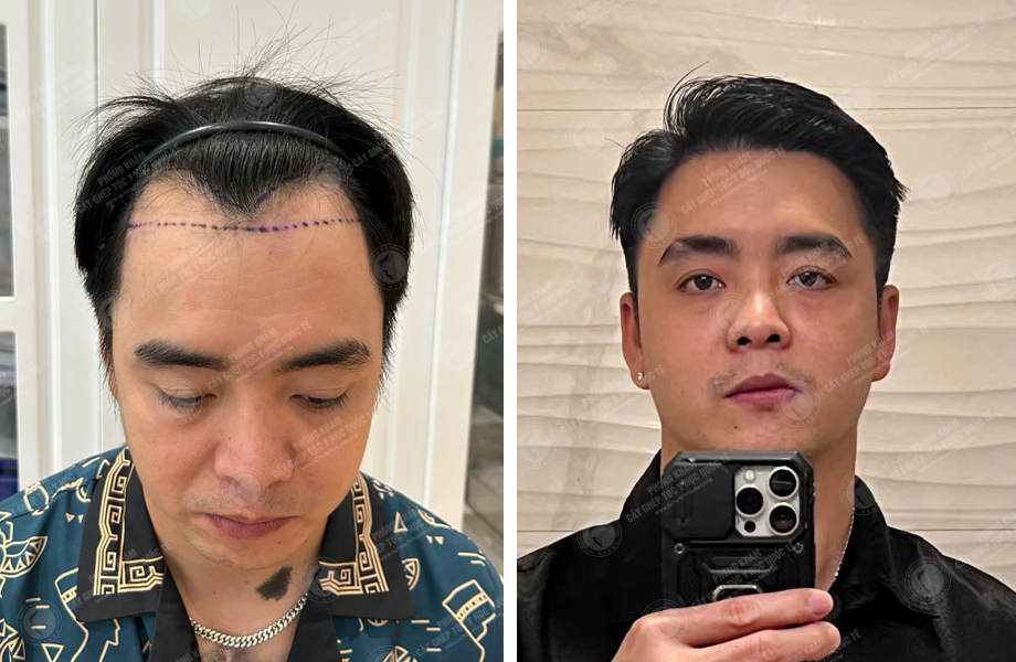  Nguyễn Lạc Quân - Cấy tóc đường chữ M 1