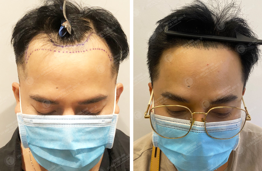  Trần Ngọc Vương - Cấy tóc đường chữ M 1