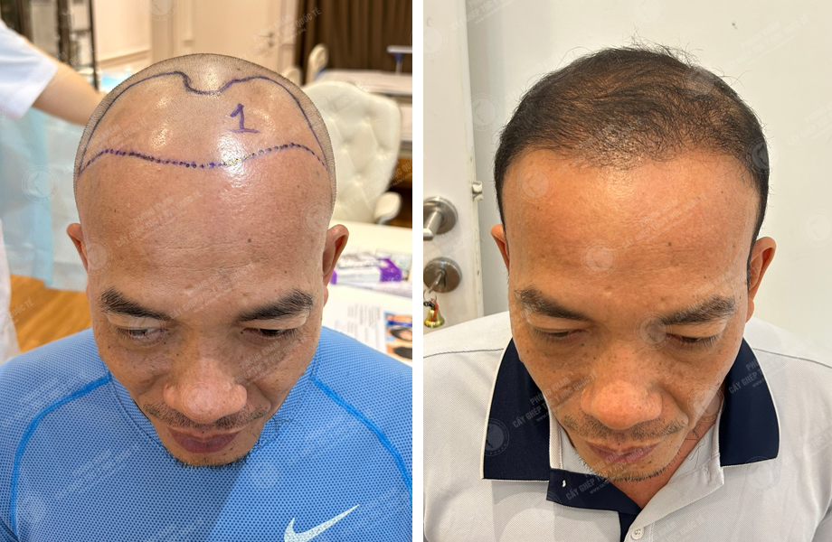  Nguyễn Đăng Linh - Cấy tóc tự thân 1