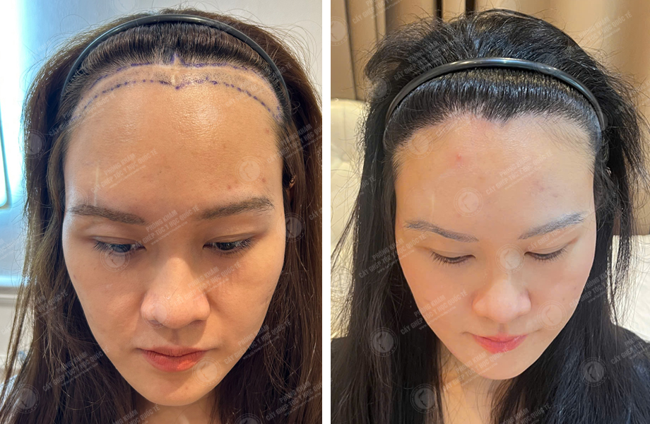  Nguyễn Minh Nguyệt - Cấy tóc đường chữ M 1