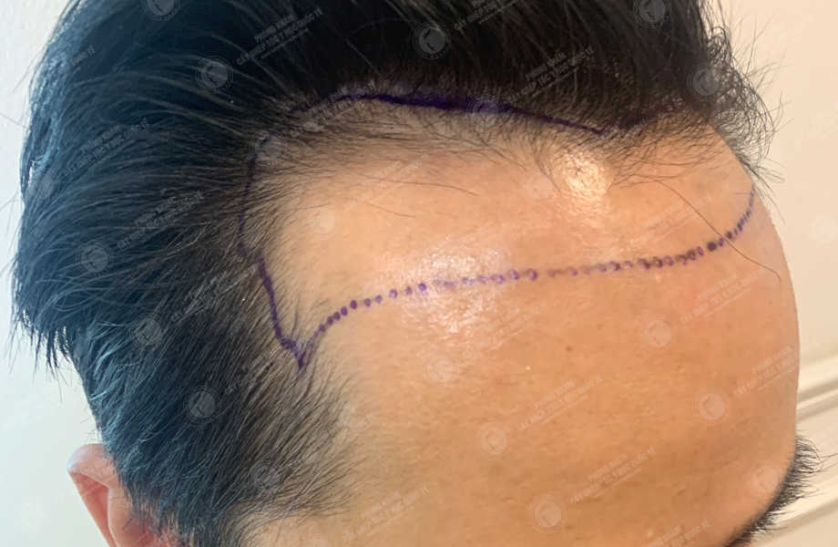 Phùng Tuấn Sơn - Cấy tóc đường chữ M 3