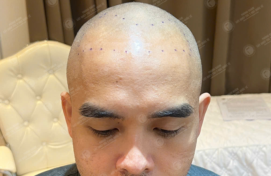 Phạm Hoàng Tuấn - Cấy tóc đường chữ M 3