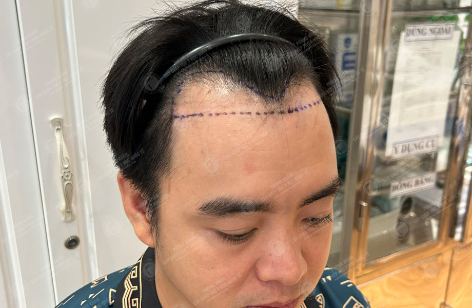 Nguyễn Lạc Quân - Cấy tóc đường chữ M 3