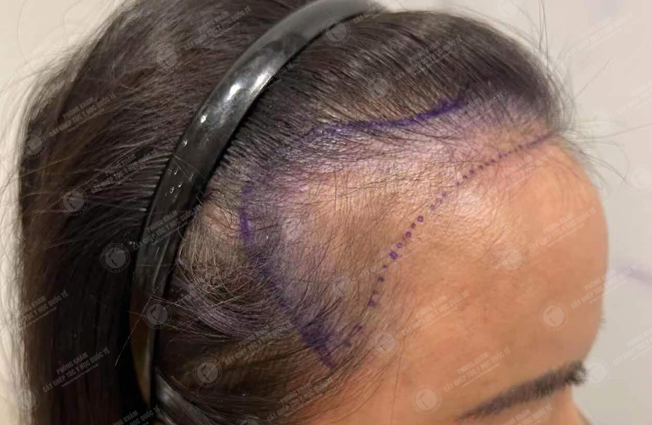 Lê Khánh Thy - Cấy tóc đường chữ M 3