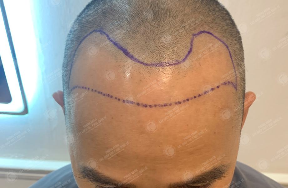 Phùng Tuấn Sơn - Cấy tóc đường chữ M 4