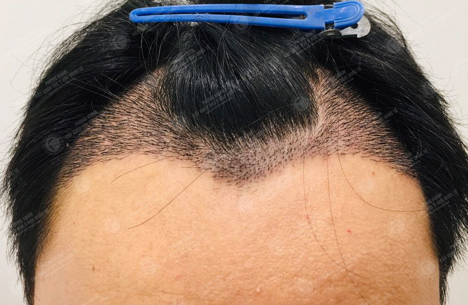 Đinh Nho Huấn - Cấy tóc đường chữ M 5