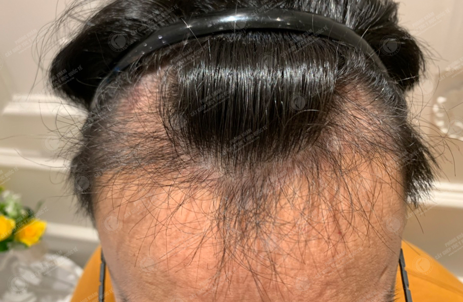 Đinh Nho Huấn - Cấy tóc đường chữ M 6