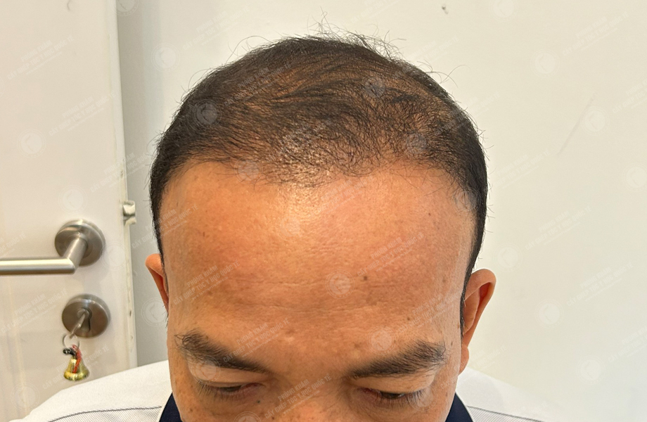 Nguyễn Đăng Linh - Cấy tóc đường chữ M 6