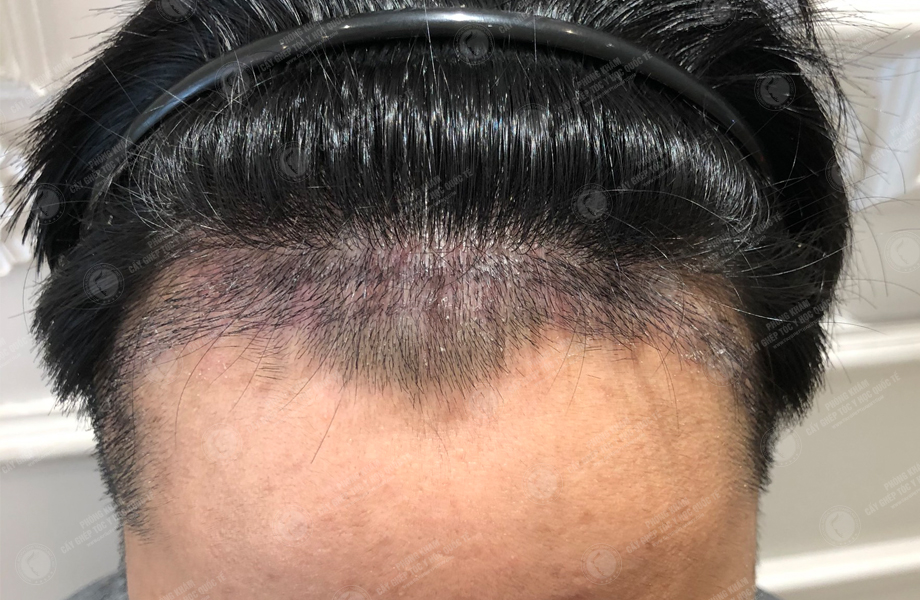 Phạm Quang Hùng - Cấy tóc trên sẹo 6