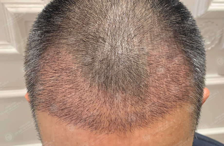 Phùng Tuấn Sơn - Cấy tóc đường chữ M 6