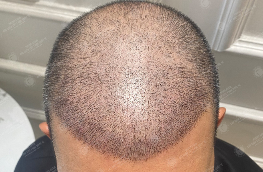 Phạm Hùng Dũng - Cấy tóc đường chữ M 6