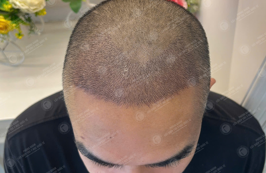 Phạm Hoàng Tuấn - Cấy tóc đường chữ M 6