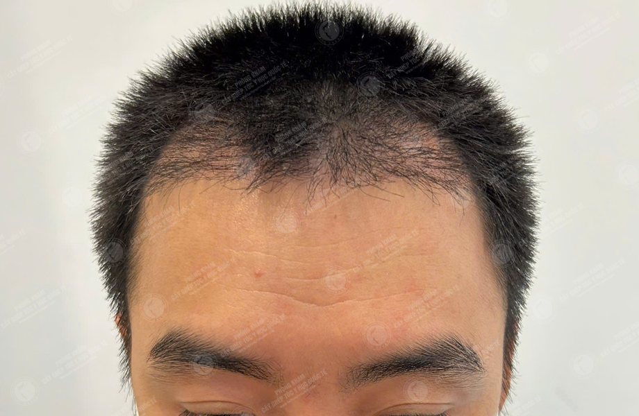Nguyễn Lạc Quân - Cấy tóc đường chữ M 6