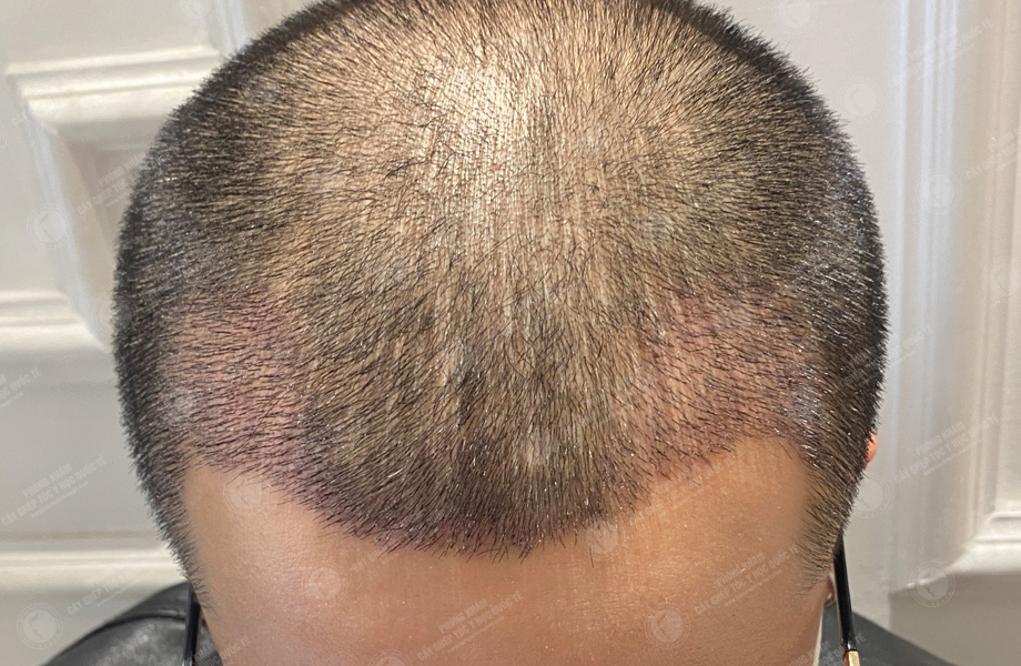 Trần Ngọc Vương - Cấy tóc đường chữ M 6