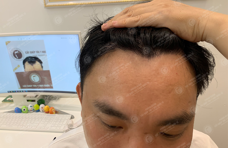 Đinh Nho Huấn - Cấy tóc đường chữ M 7