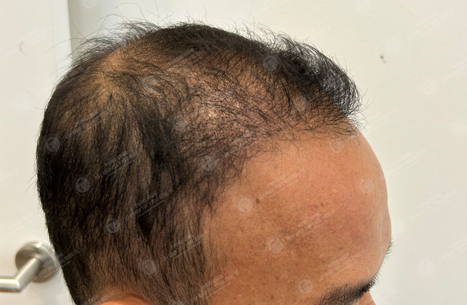 Nguyễn Đăng Linh - Cấy tóc đường chữ M 7