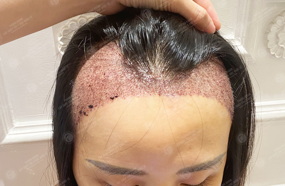 Lê Minh Thư - Cấy tóc đường chữ M 7