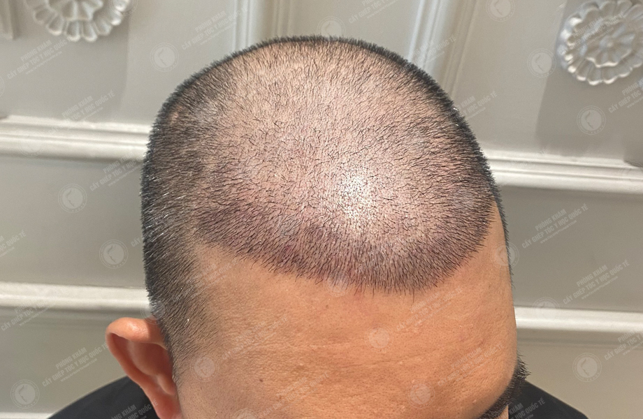 Phạm Hùng Dũng - Cấy tóc đường chữ M 7