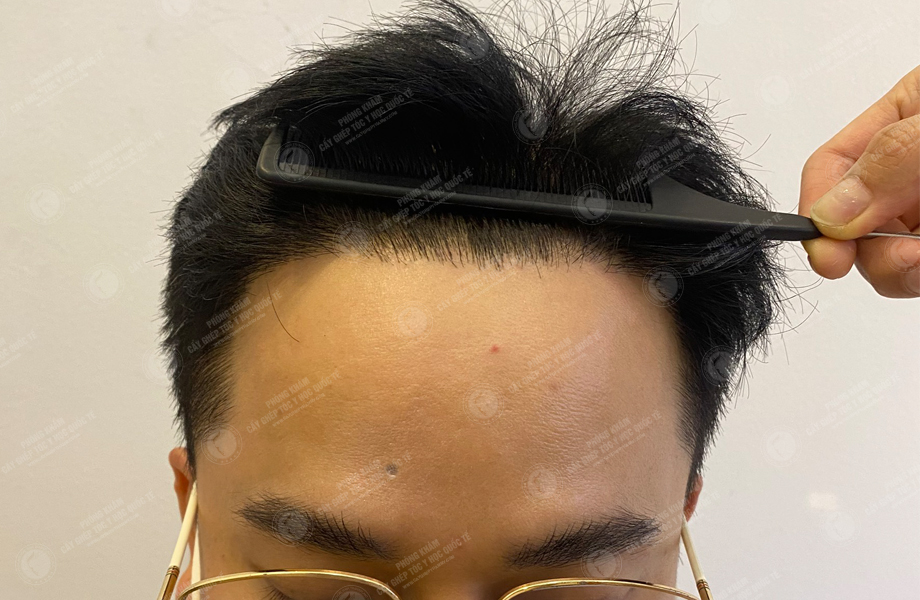 Trần Ngọc Vương - Cấy tóc đường chữ M 7